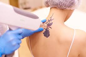 Essential Laser Tattoo Removal Tips